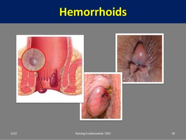 can dogs get hemorrhoids related keywords suggestions for infected hemorrhoids can dogs get hemorrhoids related keywords suggestions for infected hemorrhoids